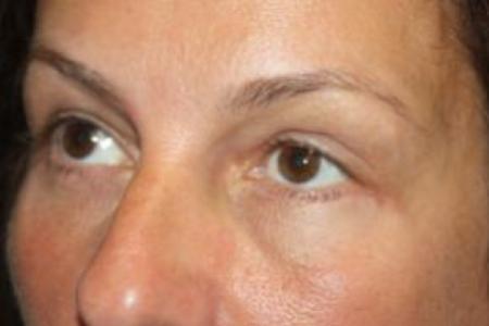 After image 2 Case #85871 - Blepharoplasty and Browlift - 49 year old female