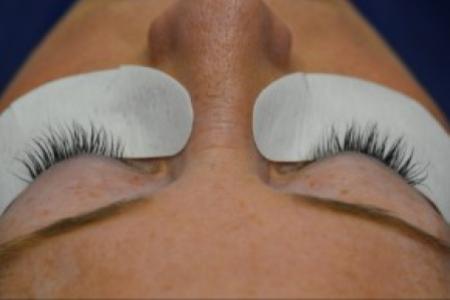 After image 1 Case #86376 - 45 year old woman treated with eyelash enhancement