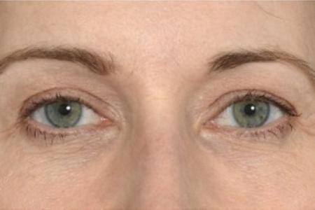 After image 1 Case #87621 - Eye Area Rejuvenation