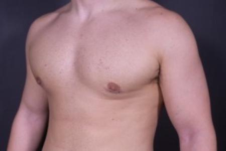 After image 2 Case #84181 - Gynecomastia