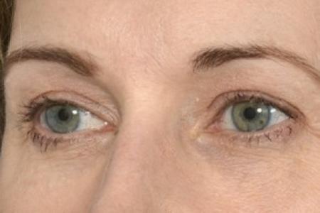 After image 2 Case #87621 - Eye Area Rejuvenation