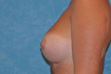 After image 3 Case #83961 - Breast Augmentation Before and After