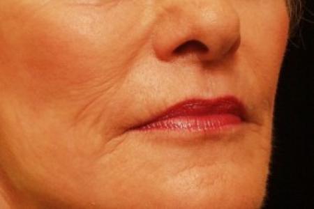 After Case #81756 - Skin Resurfacing