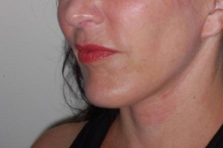 After image 1 Case #87216 - Chin Implant