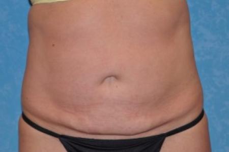 After image 1 Case #83951 - Liposuction Before and After 