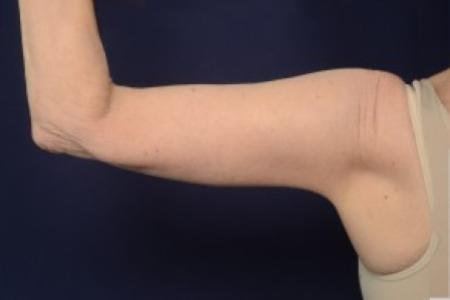 After image 2 Case #87461 - Upper Arm Lift