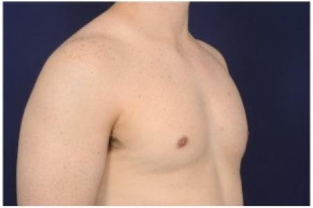After image 2 Case #86211 - 32 year old man treated with Male Breast Reduction