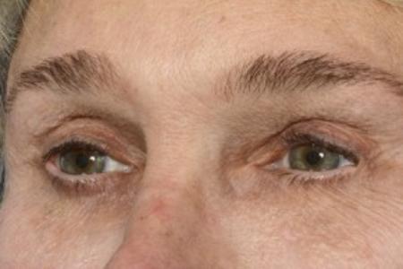 After image 3 Case #87131 - Structural Fat Grafting