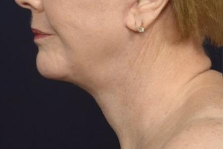 After image 3 Case #87136 - Lower Facial Rejuvenation