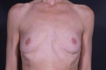 After image 1 Case #83811 - Implant Removal