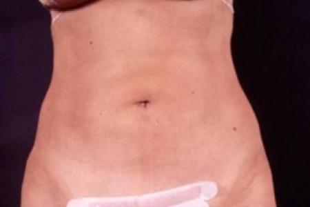 After image 1 Case #81656 - Liposuction