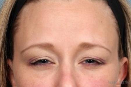 After Case #86811 - 35-45 year old woman treated with Botox