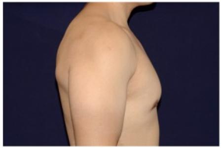 After image 3 Case #82176 - Gynecomastia