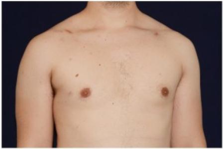 After image 2 Case #82066 - Gynecomastia