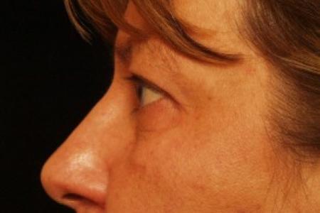 After image 2 Case #81741 - Eyelid Surgery