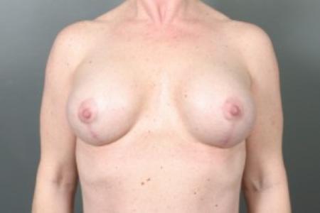 After image 1 Case #83241 - Breast Lift/Augmentation with Shaped Silicone Implants