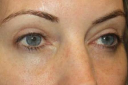 After image 2 Case #85846 - Blepharoplasty - Upper and Lower Lids - 42 year old female