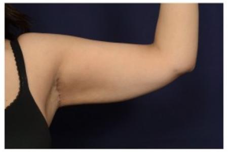 After image 1 Case #87066 - Upper Arm Lift