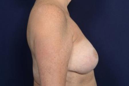 After image 3 Case #87466 - Augmentation Mastopexy