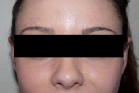 After image 1 Case #83046 - Otoplasty
