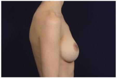After image 3 Case #86926 - Breast Augmentation