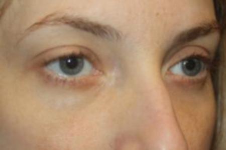 After image 3 Case #85876 - Blepharoplasty - Lower Lids Only - 34 year old female