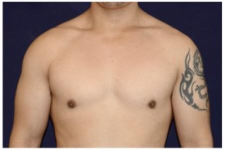 After image 1 Case #82176 - Gynecomastia