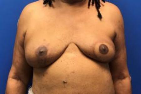 After image 1 Case #88426 - Breast Reconstruction on a 63 year old female