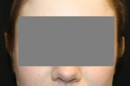 After image 1 Case #84636 - Otoplasty - 17 year old female