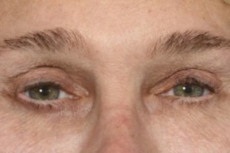 After image 1 Case #87131 - Structural Fat Grafting