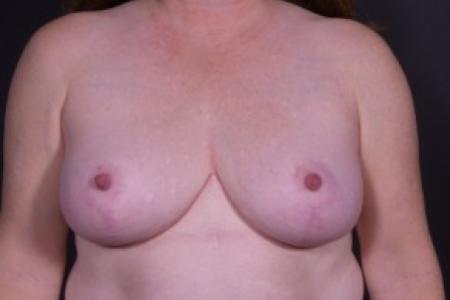 After image 1 Case #85131 - Reduction Mastopexy