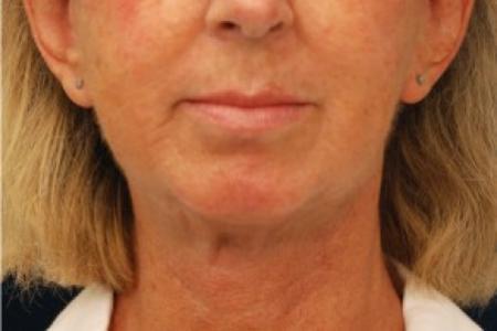 After image 1 Case #82146 - Neck Lift