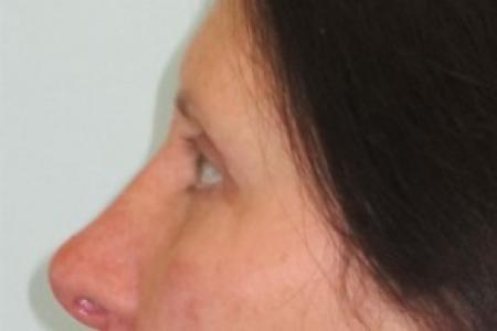 After image 2 Case #82616 - Upper and lower eyelids
