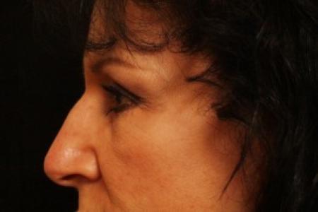 After image 2 Case #81736 - Eyelid Surgery