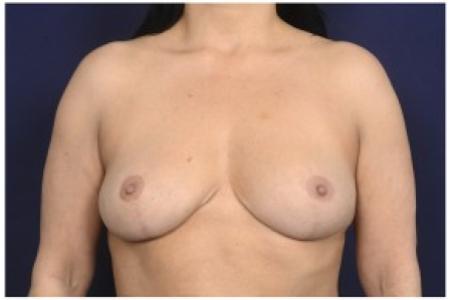 After image 1 Case #86881 - Breast Reduction
