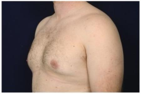After image 2 Case #85611 - Gynecomastia