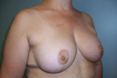 After image 2 Case #83166 - Breast Reduction 