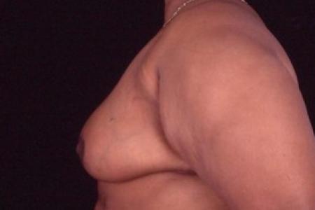 After image 3 Case #81461 - Breast Reduction/Lift