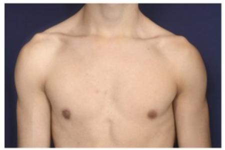 After image 1 Case #87541 - Gynecomastia