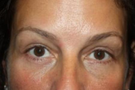 After image 1 Case #85871 - Blepharoplasty and Browlift - 49 year old female