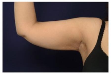 After image 1 Case #87061 - Upper Arm Lift