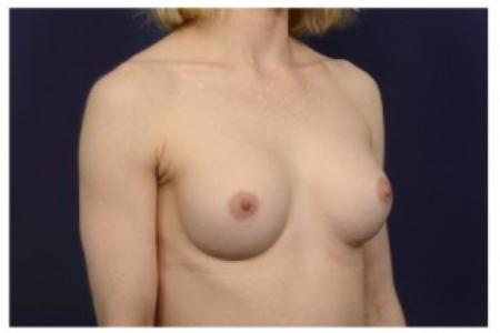 After image 2 Case #87026 - Breast Augmentation