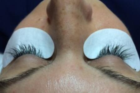 After image 1 Case #86341 - 37 year old woman treated with eyelash enhancement