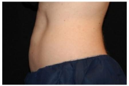 After Case #86356 - 40 yr old treated with nonsurgical fat reduction.