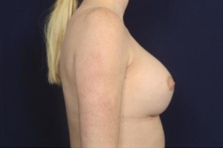 After image 3 Case #87456 - Breast Augmentation