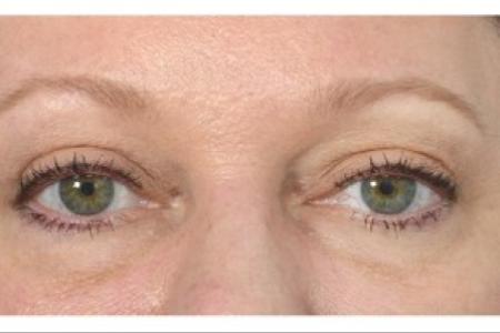 After image 1 Case #87121 - Eye Area Rejuvenation