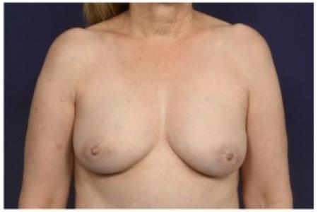 After image 1 Case #84761 - Fat Grafting of Breasts