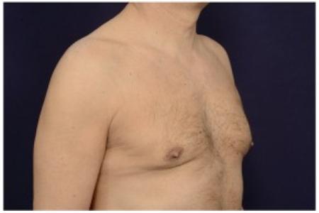 After image 2 Case #84506 - Gynecomastia