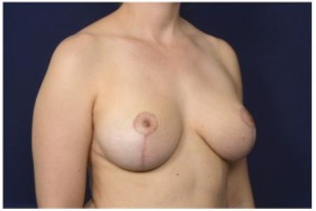 After image 2 Case #84611 - 35-44 year old woman treated with Breast Reduction