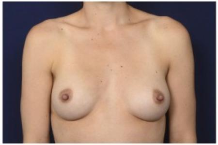 After image 1 Case #84596 - 25-34 year old woman treated with Breast Augmentation